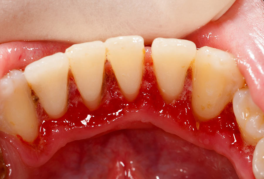 Gum Disease Treatment Balwyn North