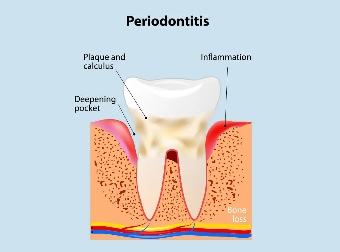 periodontal disease Balwyn North
