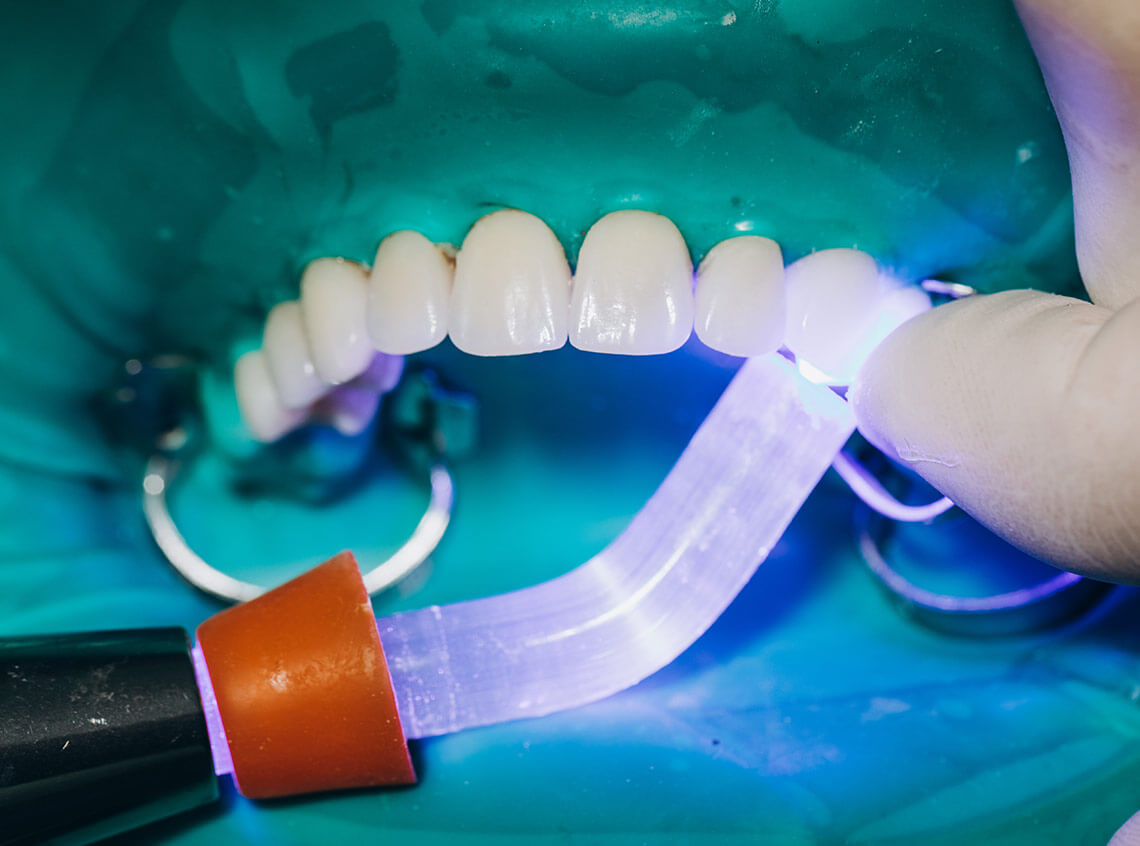 Porcelain veneers Balwyn North