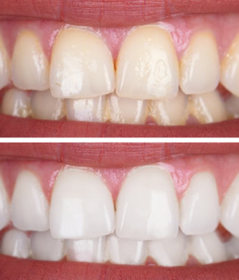 Professional Teeth Whitening Balwyn North