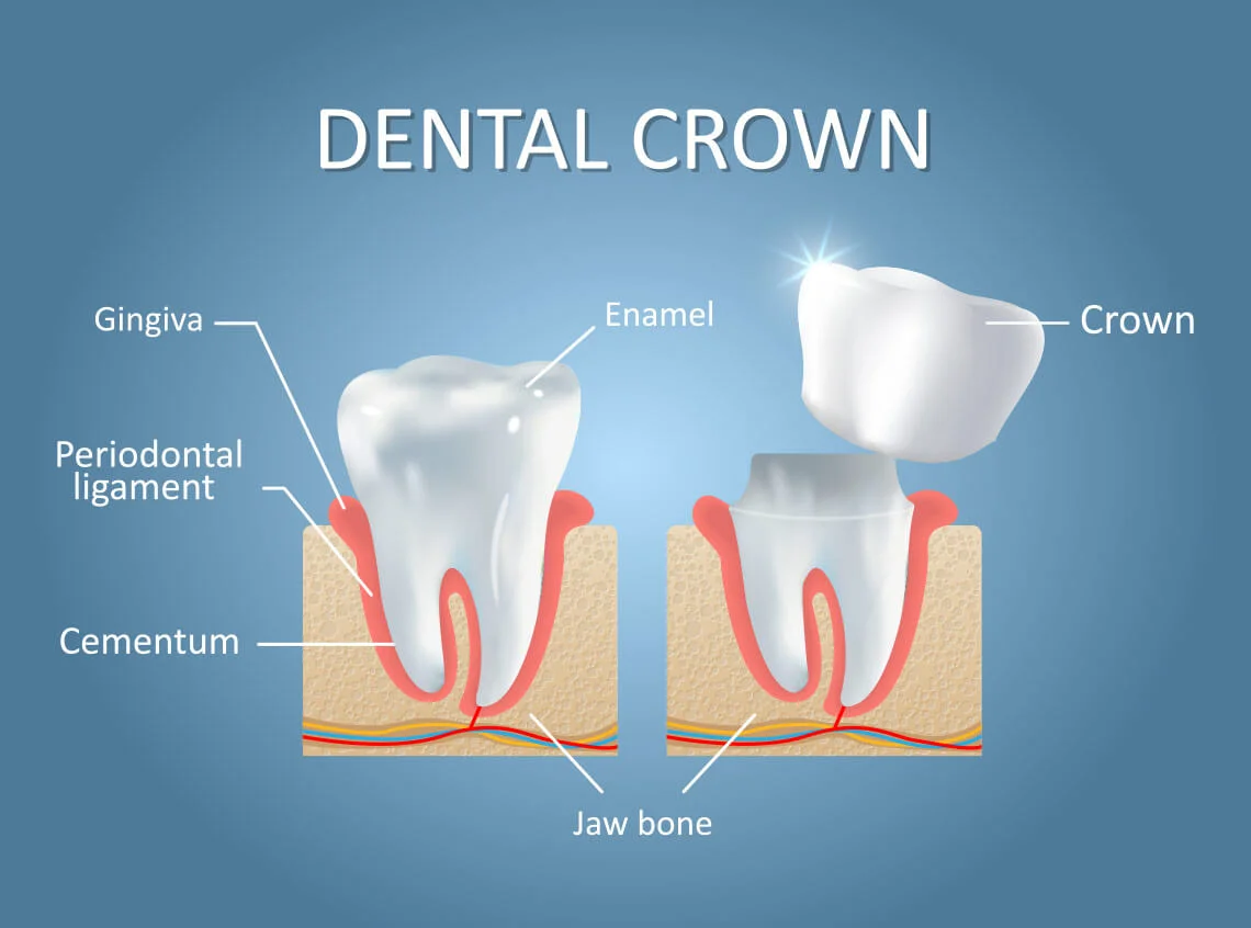 dental crown Balwyn North