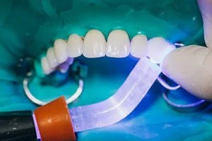 Dental Veneers Templestowe Lower