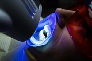 teeth whitening in Bulleen