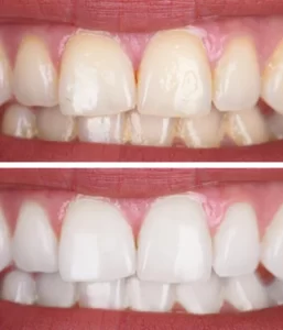 Types of teeth whitening